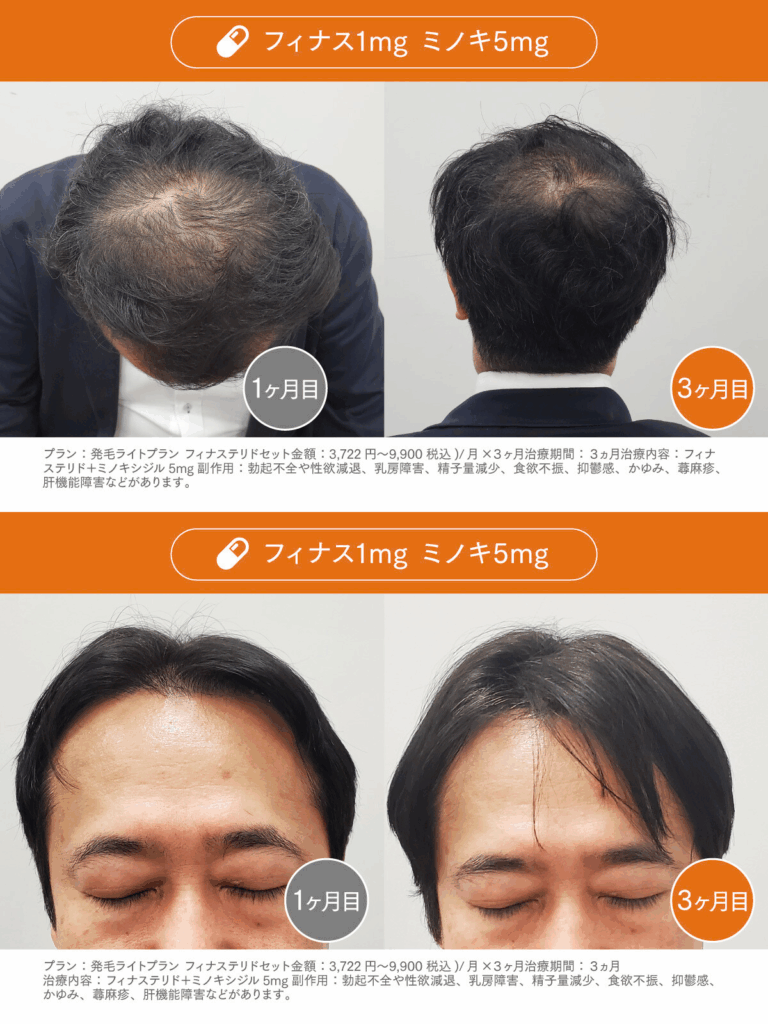 Before /After